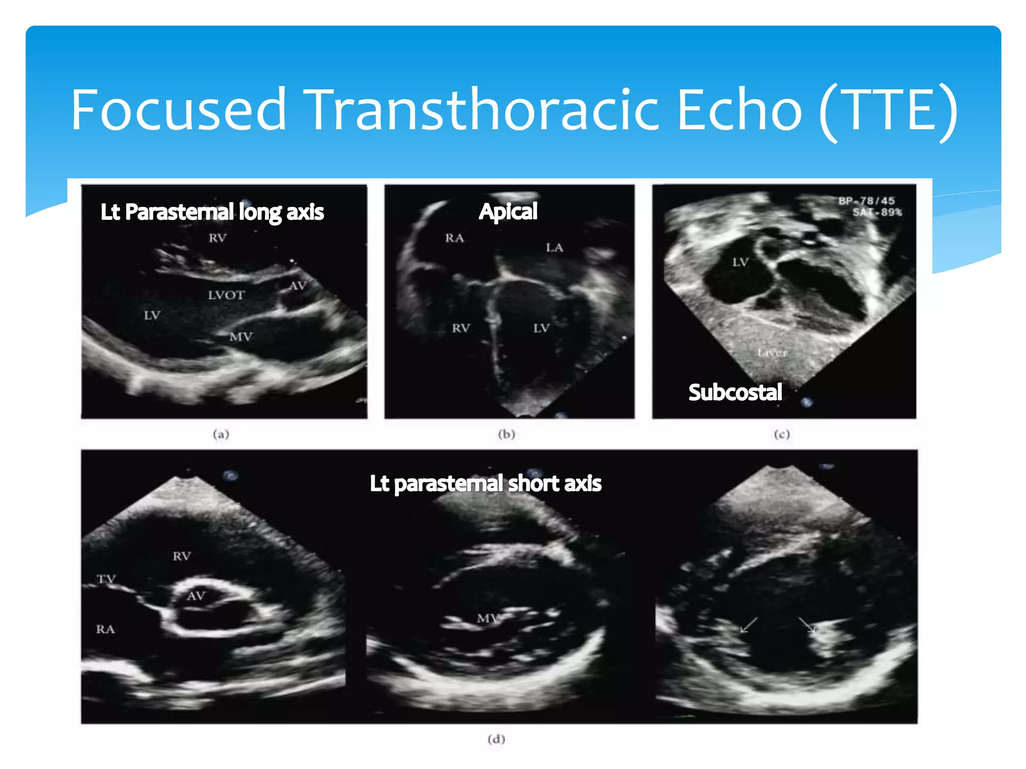 Uses of Ultrasound in Anesthesiology | PPTX