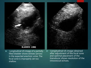  Longitudinal US image of a partially
filled bladder shows echoes (arrow)
in the expected anechoic urine. The
focal zone is improperly set too
shallow.
 Longitudinal US image obtained
after adjustment of the focal zone
and optimal placement of the
transducer shows resolution of the
intravesical echoes.
 
