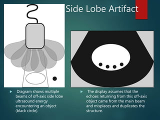 Side Lobe Artifact
 Diagram shows multiple
beams of off-axis side lobe
ultrasound energy
encountering an object
(black circle).
 The display assumes that the
echoes returning from this off-axis
object came from the main beam
and misplaces and duplicates the
structure.
 