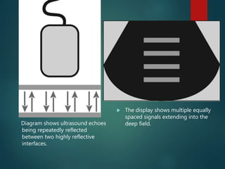 Diagram shows ultrasound echoes
being repeatedly reflected
between two highly reflective
interfaces.
 The display shows multiple equally
spaced signals extending into the
deep field.
 