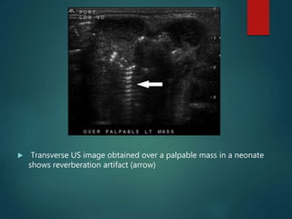  Transverse US image obtained over a palpable mass in a neonate
shows reverberation artifact (arrow)
 