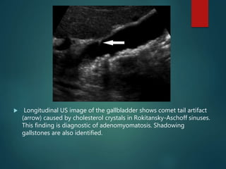  Longitudinal US image of the gallbladder shows comet tail artifact
(arrow) caused by cholesterol crystals in Rokitansky-Aschoff sinuses.
This finding is diagnostic of adenomyomatosis. Shadowing
gallstones are also identified.
 