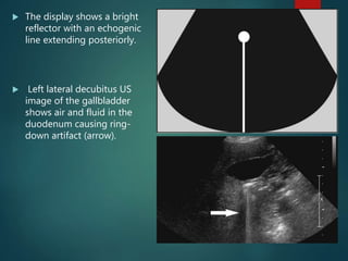  The display shows a bright
reflector with an echogenic
line extending posteriorly.
 Left lateral decubitus US
image of the gallbladder
shows air and fluid in the
duodenum causing ring-
down artifact (arrow).
 