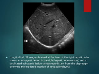  Longitudinal US image obtained at the level of the right hepatic lobe
shows an echogenic lesion in the right hepatic lobe (cursors) and a
duplicated echogenic lesion (arrow) equidistant from the diaphragm
overlying the expected location of lung parenchyma.
 