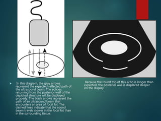  In this diagram, the gray arrows
represent the expected reflected path of
the ultrasound beam. The echoes
returning from the posterior wall of the
depicted structure will be displayed
properly. The black arrows represent the
path of an ultrasound beam that
encounters an area of focal fat. The
dashed lines indicate that the sound
beam travels slower in the focal fat than
in the surrounding tissue.
Because the round trip of this echo is longer than
expected, the posterior wall is displaced deeper
on the display.
 