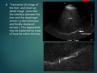  Transverse US image of
the liver and close-up
detail image show that
the interface between the
liver and the diaphragm
(arrow ) is discontinuous
and focally displaced
(arrows ). This appearance
may be explained by areas
of focal fat within the liver.
 