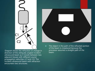 Diagram shows the refraction or change in
direction of the obliquely angled incident
ultrasound beam as it travels between two
adjacent tissues with different sound
propagation velocities (C1 and C2). The
incident ultrasound beam with refraction
encounters two structures.
 The object in the path of the refracted portion
of the beam is misplaced because the
processor assumes a straight path of the
beam.
 