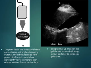  Diagram shows the ultrasound beam
encountering a strongly attenuating
material. The echoes received from
points distal to this material are
significantly lower in intensity than
echoes received from a similar depth.
 Longitudinal US image of the
gallbladder shows shadowing
(arrow) posterior to echogenic
gallstones.
 