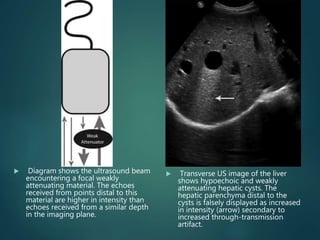  Diagram shows the ultrasound beam
encountering a focal weakly
attenuating material. The echoes
received from points distal to this
material are higher in intensity than
echoes received from a similar depth
in the imaging plane.
 Transverse US image of the liver
shows hypoechoic and weakly
attenuating hepatic cysts. The
hepatic parenchyma distal to the
cysts is falsely displayed as increased
in intensity (arrow) secondary to
increased through-transmission
artifact.
 