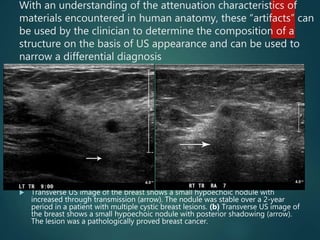 With an understanding of the attenuation characteristics of
materials encountered in human anatomy, these “artifacts” can
be used by the clinician to determine the composition of a
structure on the basis of US appearance and can be used to
narrow a differential diagnosis
 Transverse US image of the breast shows a small hypoechoic nodule with
increased through transmission (arrow). The nodule was stable over a 2-year
period in a patient with multiple cystic breast lesions. (b) Transverse US image of
the breast shows a small hypoechoic nodule with posterior shadowing (arrow).
The lesion was a pathologically proved breast cancer.
 