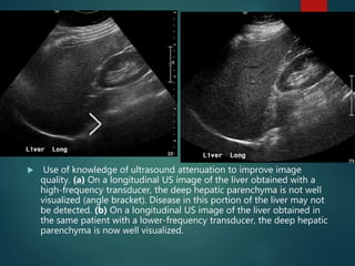  Use of knowledge of ultrasound attenuation to improve image
quality. (a) On a longitudinal US image of the liver obtained with a
high-frequency transducer, the deep hepatic parenchyma is not well
visualized (angle bracket). Disease in this portion of the liver may not
be detected. (b) On a longitudinal US image of the liver obtained in
the same patient with a lower-frequency transducer, the deep hepatic
parenchyma is now well visualized.
 