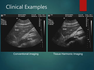 Clinical Examples
Conventional imaging Tissue Harmonic Imaging
liver liver
aorta
aorta
 