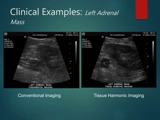 Clinical Examples: Left Adrenal
Mass
Conventional imaging Tissue Harmonic Imaging
 