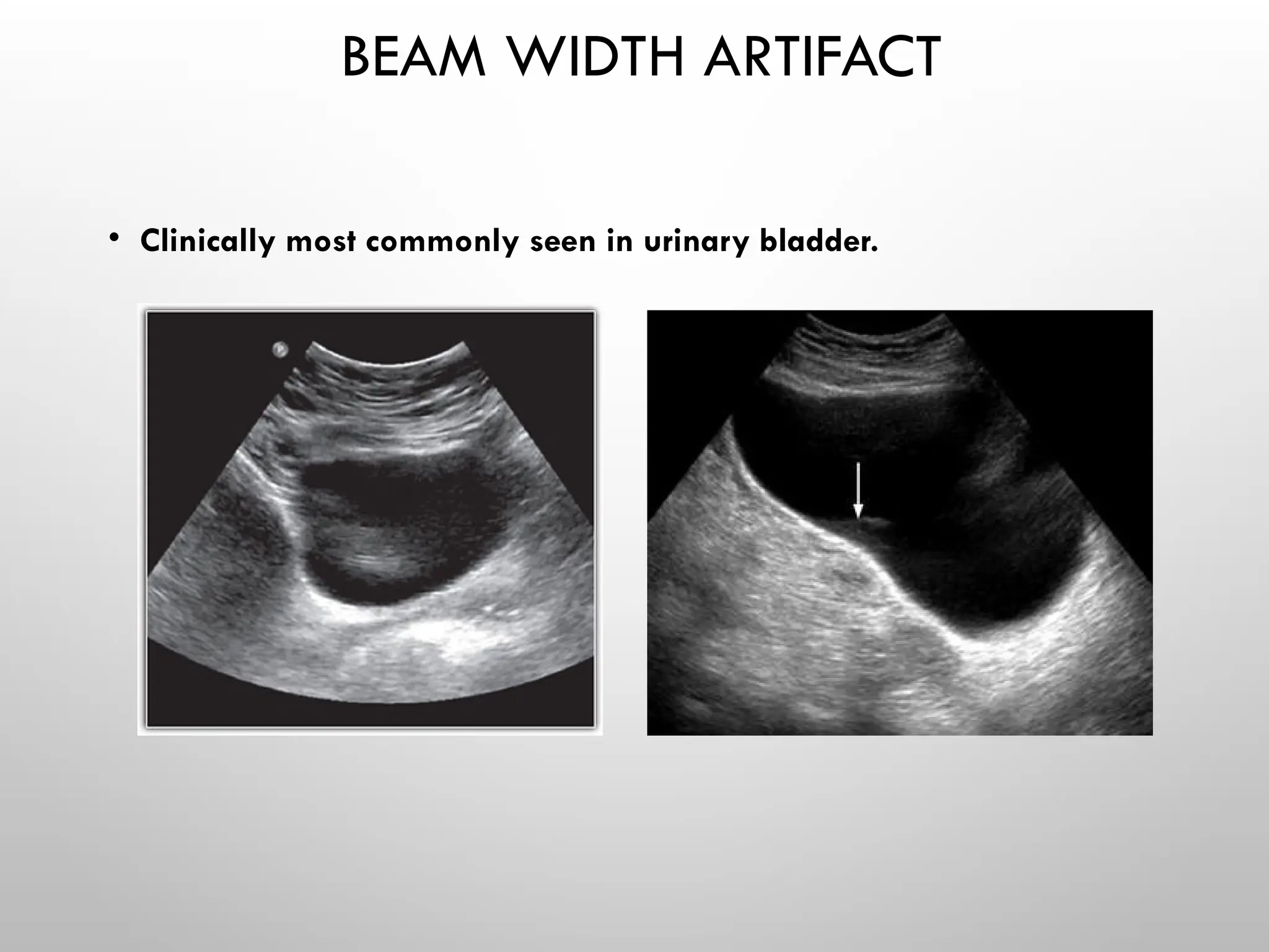 BEAM WIDTH ARTIFACT
• Clinically most commonly seen in urinary bladder.
 