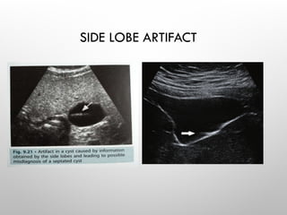SIDE LOBE ARTIFACT
 