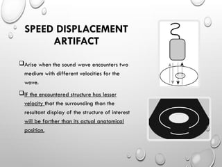 SPEED DISPLACEMENT
ARTIFACT
Arise when the sound wave encounters two
medium with different velocities for the
wave.
If the encountered structure has lesser
velocity that the surrounding than the
resultant display of the structure of interest
will be farther than its actual anatomical
position.
 