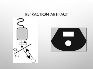 REFRACTION ARTIFACT
 