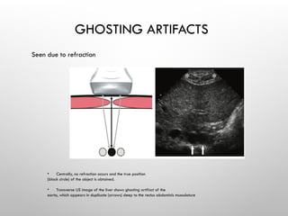 GHOSTING ARTIFACTS
Seen due to refraction
• Centrally, no refraction occurs and the true position
(black circle) of the object is obtained.
• Transverse US image of the liver shows ghosting artifact of the
aorta, which appears in duplicate (arrows) deep to the rectus abdominis musculature
 