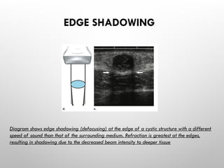 EDGE SHADOWING
Diagram shows edge shadowing (defocusing) at the edge of a cystic structure with a different
speed of sound than that of the surrounding medium. Refraction is greatest at the edges,
resulting in shadowing due to the decreased beam intensity to deeper tissue
 