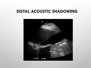 DISTAL ACOUSTIC SHADOWING
 