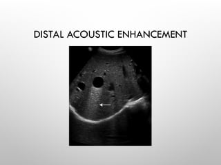 DISTAL ACOUSTIC ENHANCEMENT
 