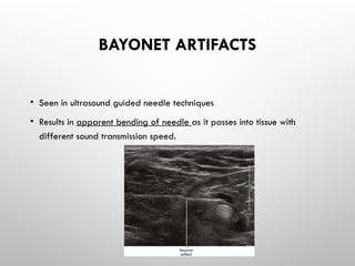 BAYONET ARTIFACTS
• Seen in ultrasound guided needle techniques
• Results in apparent bending of needle as it passes into tissue with
different sound transmission speed.
 