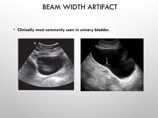 BEAM WIDTH ARTIFACT
• Clinically most commonly seen in urinary bladder.
 