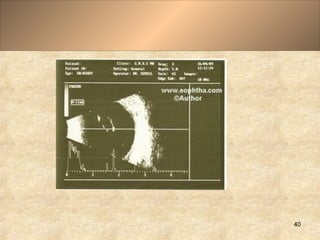 Usg Scan Sample USG B Scan | PPT