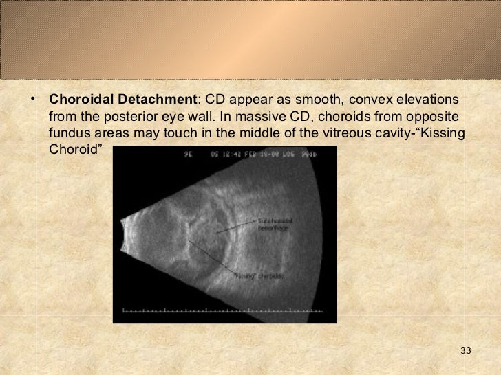 32 33 O Choroidal Detachment 32 33 O Choroidal Detachment