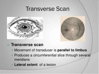 Transverse position
− Most commonly used position
− Shows about 6 clock hours
− Used for basic screening
− Detects lateral extent of pathology
− Probe is placed opposite to the examined
meridian
3/15/2013 29
 