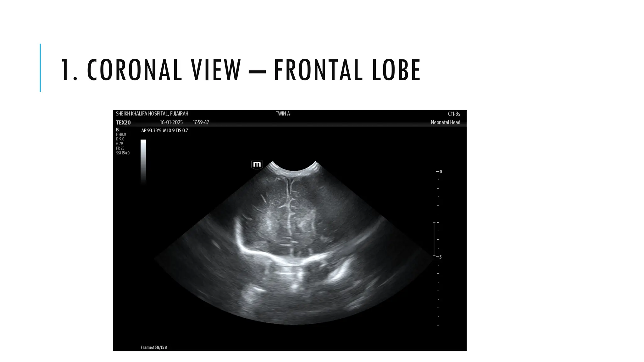USG CRANIUM VIEWS, NEOPOCUS. Saggital views Coronal views.pptx