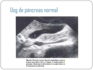 Usg de páncreas normal
 
