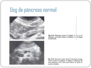 Usg de páncreas normal
 