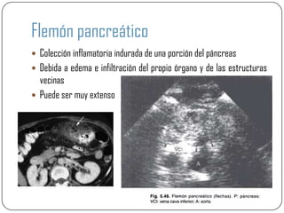 Flemón pancreático
 Colección inflamatoria indurada de una porción del páncreas
 Debida a edema e infiltración del propio órgano y de las estructuras
  vecinas
 Puede ser muy extenso
 