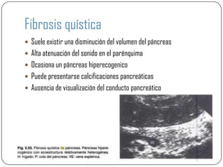 Fibrosis quística
 Suele existir una disminución del volumen del páncreas
 Alta atenuación del sonido en el parénquima
 Ocasiona un páncreas hiperecogenico
 Puede presentarse calcificaciones pancreáticas
 Ausencia de visualización del conducto pancreático
 