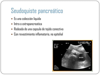 Seudoquiste pancreático
 Es una colección liquida
 Intra o extrapancreatica
 Rodeada de una capsula de tejido conectivo
 Con revestimiento inflamatorio, no epitelial
 