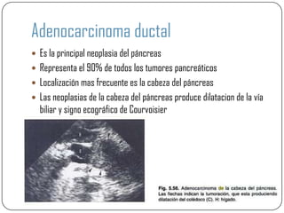 Adenocarcinoma ductal
 Es la principal neoplasia del páncreas
 Representa el 90% de todos los tumores pancreáticos
 Localización mas frecuente es la cabeza del páncreas
 Las neoplasias de la cabeza del páncreas produce dilatacion de la vía
  biliar y signo ecográfico de Courvoisier
 