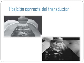 Posición correcta del transductor
 