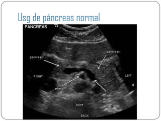 Usg de páncreas normal
 