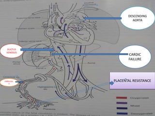 PLACENTAL RESISTANCE
CARDIC
FAILURE
UMBILICAL.
V
DUCTUS
VENOSUS
DESCENDING
AORTA
 