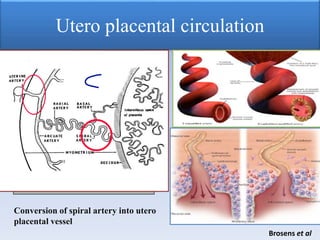 Utero placental circulation
Conversion of spiral artery into utero
placental vessel
Brosens et al
 