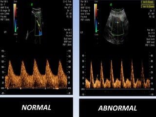 NORMAL ABNORMAL
 