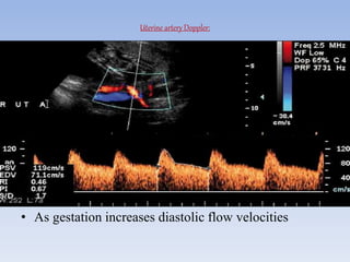Uterine artery Doppler:
• As gestation increases diastolic flow velocities
•High diastolic flow velocities
 