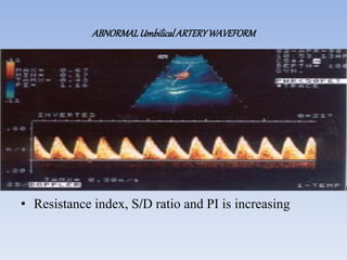 ABNORMALUmbilicalARTERYWAVEFORM
• Resistance index, S/D ratio and PI is increasing
 