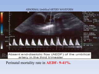 ABNORMAL Umbilical ARTERY WAVEFORM
Perinatal mortality rate in AEDF- 9-41%.
 
