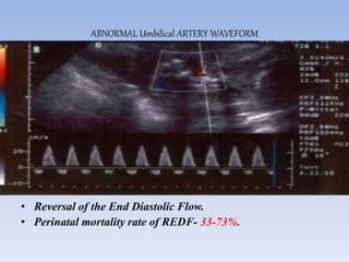 ABNORMAL Umbilical ARTERY WAVEFORM
• Reversal of the End Diastolic Flow.
• Perinatal mortality rate of REDF- 33-73%.
 