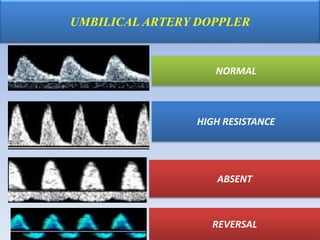 UMBILICAL ARTERY DOPPLER
Umbilical arteries
NORMAL
HIGH RESISTANCE
ABSENT
REVERSAL
 