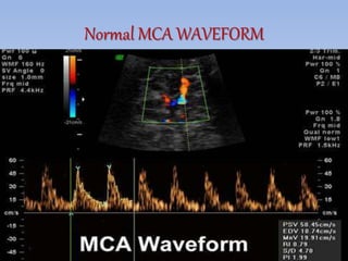 Normal MCA WAVEFORM
 