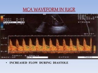 MCA WAVEFORM IN IUGR
• INCREASED FLOW DURING DIASTOLE
 