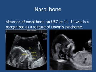USG evaluation of fetal anomalies[Replica].pptx